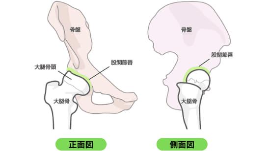 股関節唇損傷の図解