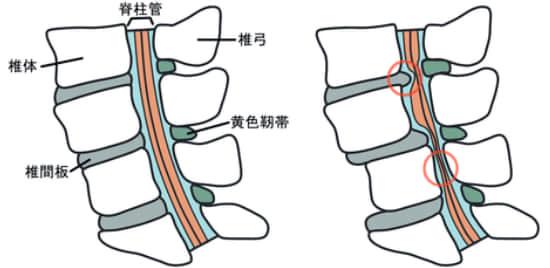 脊柱管狭窄症の図解