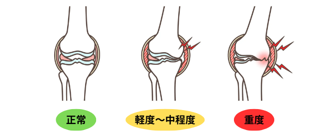 変形性膝関節症の図解