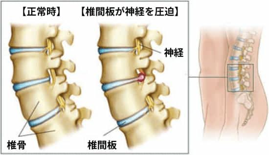 腰椎椎間板ヘルニアの図解