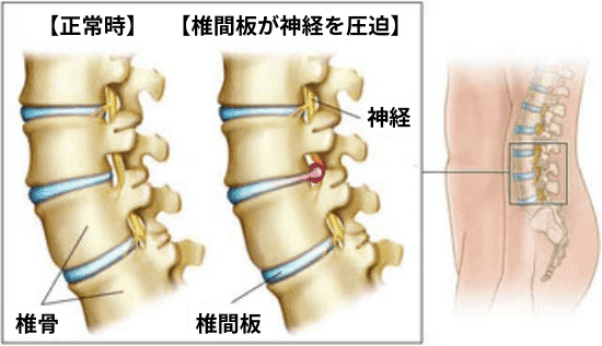 腰椎椎間板ヘルニアの図解