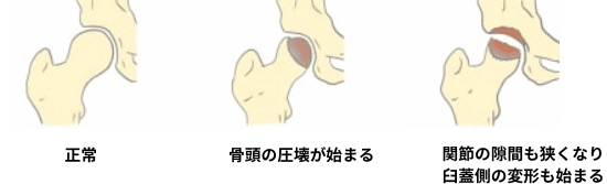 大腿骨頭壊死の図解