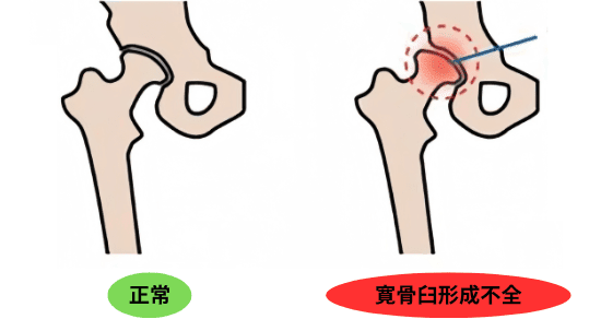 寛骨臼形成不全の図解