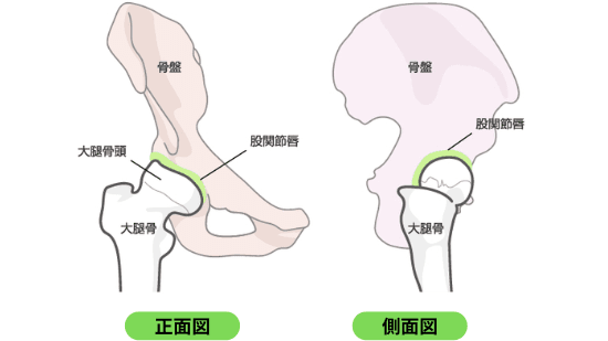 股関節唇損傷の図解