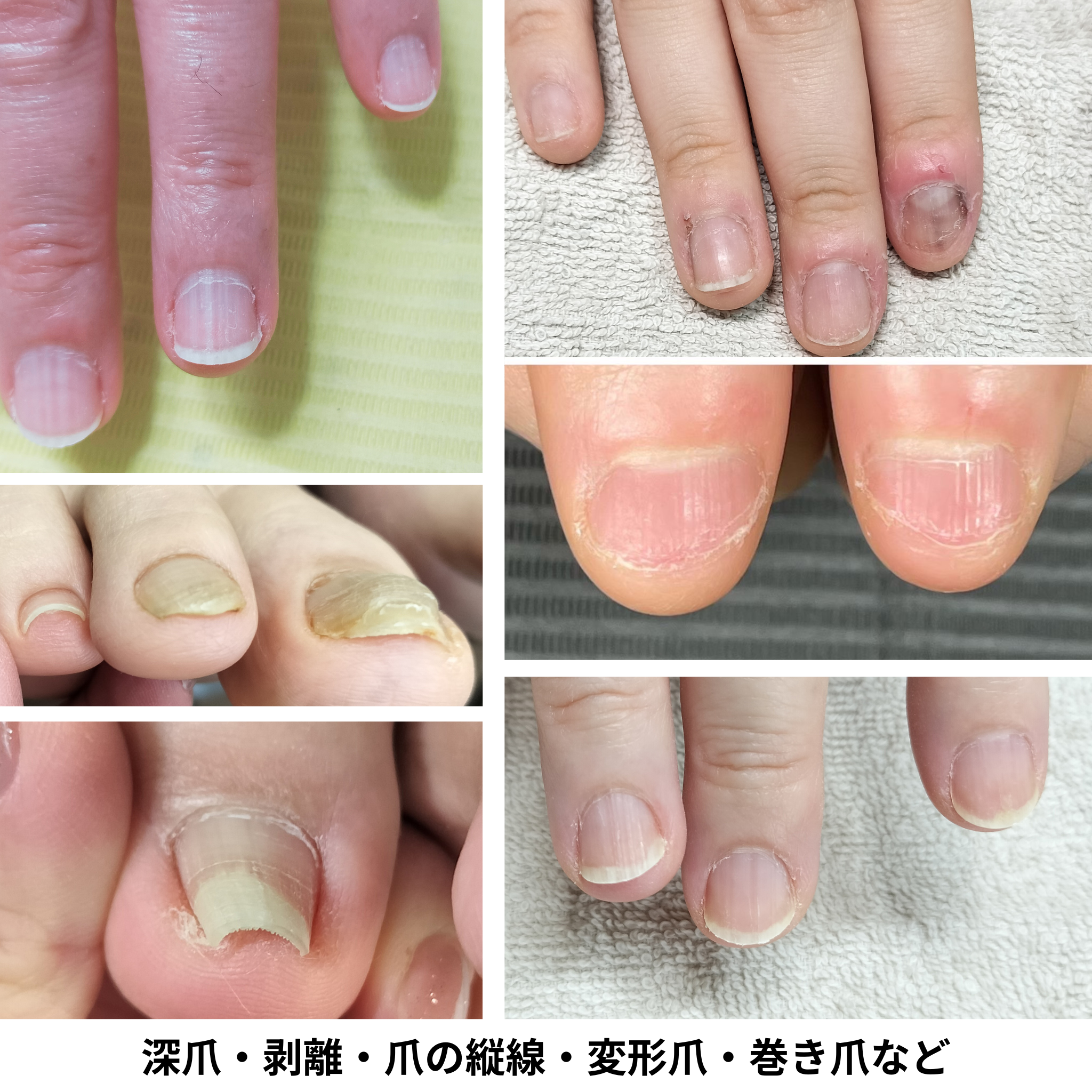 ひたちなか市】深爪・巻き爪・爪トラブル専門サロン SPICA