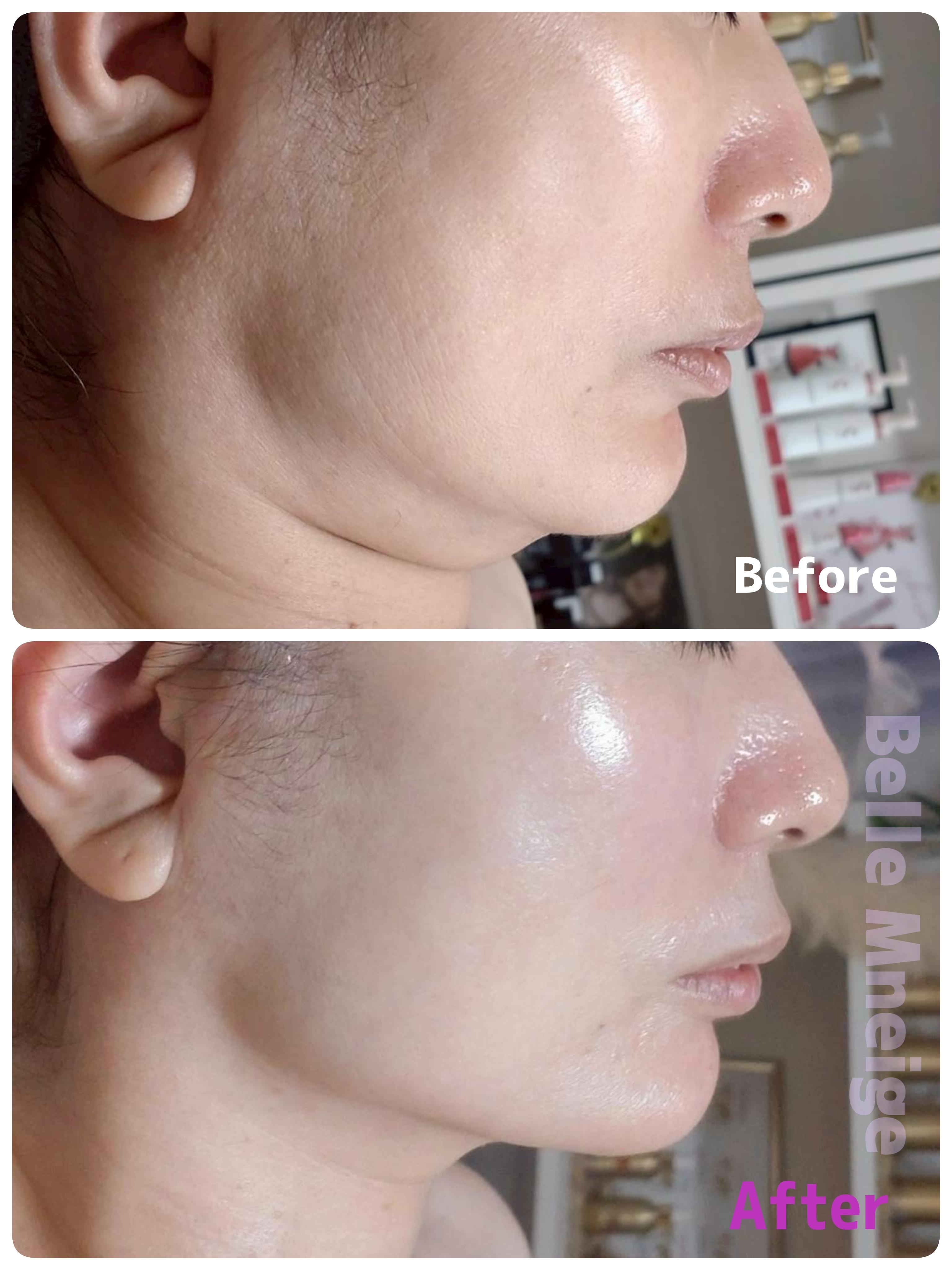 50代女性の横向きリフトアップのビフォーアフター