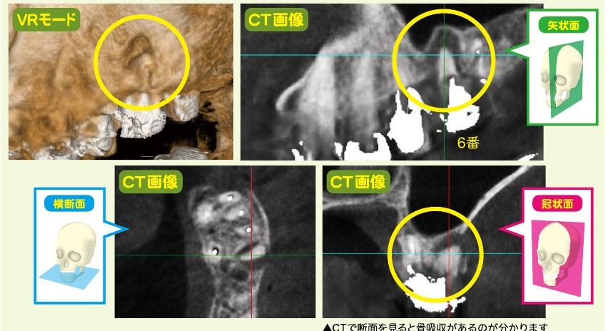 パノラマで見えない病巣