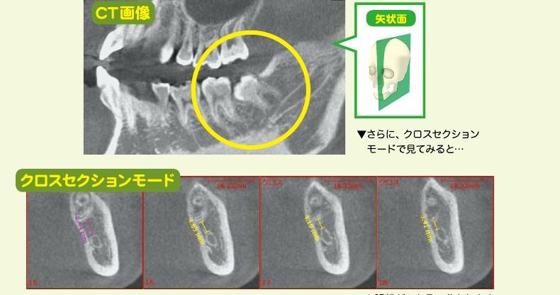クロスセクションでの距離計測