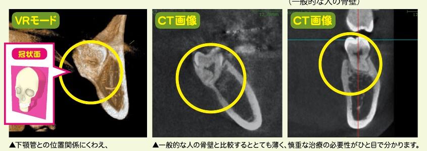 親知らずと下顕管の位置関係
