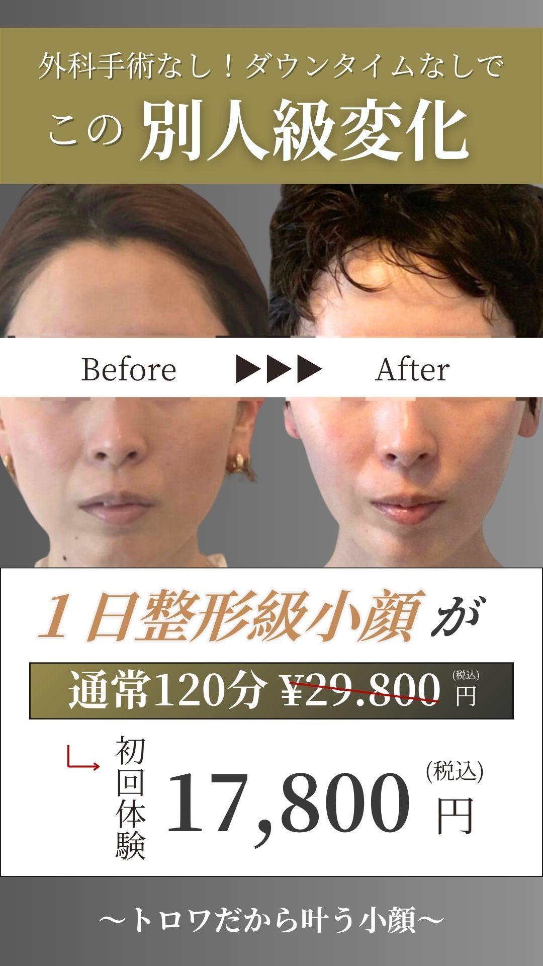 長野市エステでのたるみ改善　小顔　整形　別人級　施術前後の比較写真　17800円