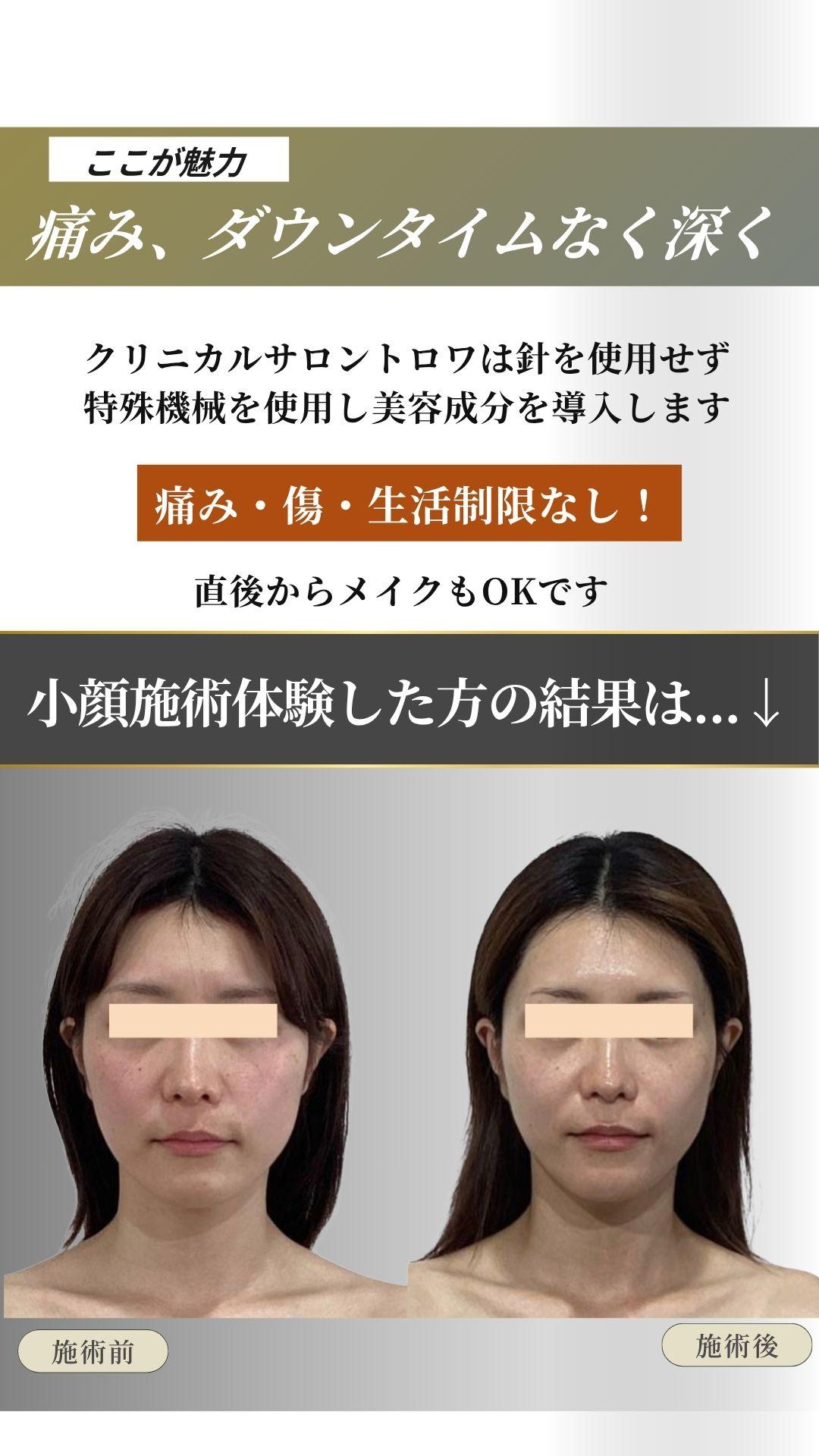 痛み、傷、ダウンタイムなしで劇的ビフォーアフター　長野市エステ