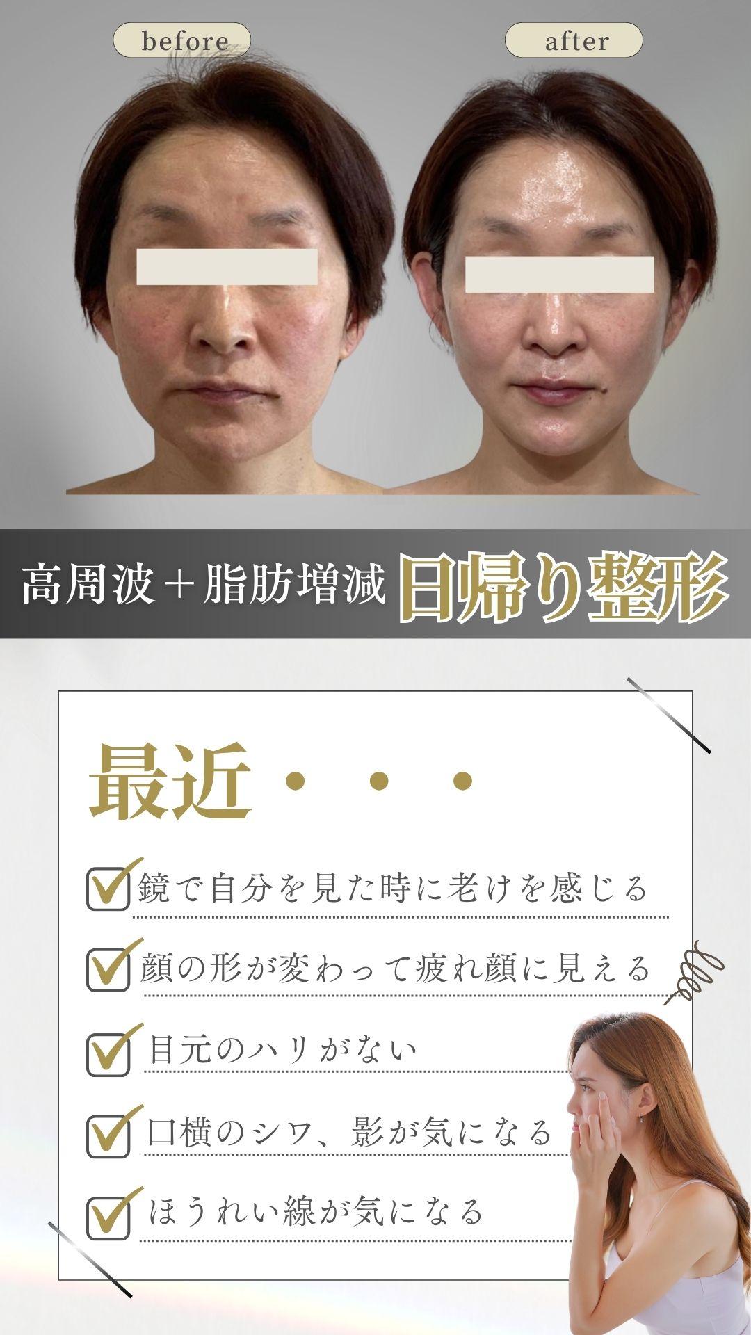 顔が大きくなった　頬全体がたるんでいる　フェイスラインがぼやける　疲れ顔　高周波と脂肪増減の施術で変化