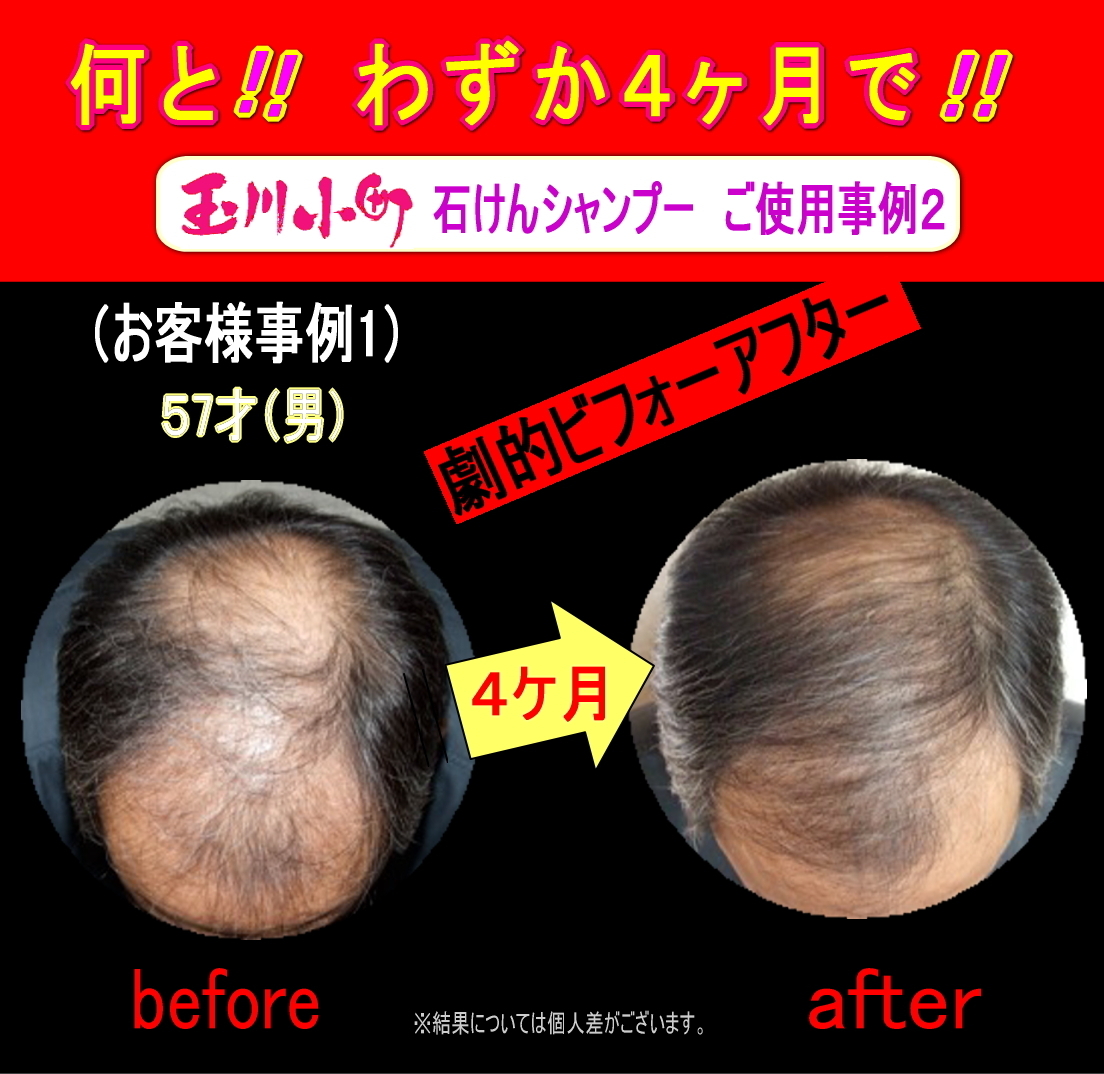 知り合いの社長の髪の毛がシャンプーを使い始めて僅か4ヶ月後の結果、明らかに髪の毛が戻っている比較写真です。