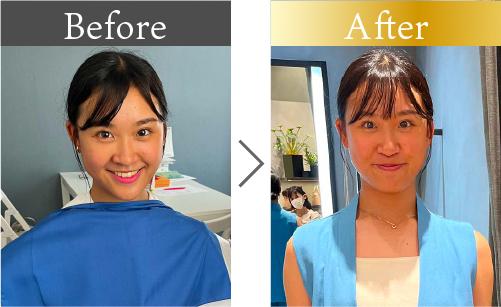 10代女性のビフォーアフター。パーソナルカラー診断を受け、似合う水色の服へ着替えた様子。