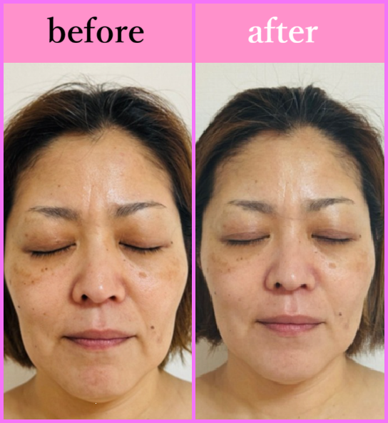 ワックス美顔 BeforeAfter