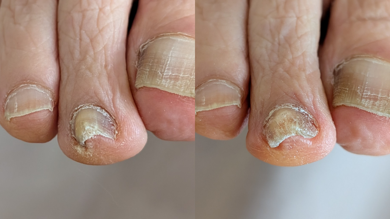 人差し指での巻き爪補正