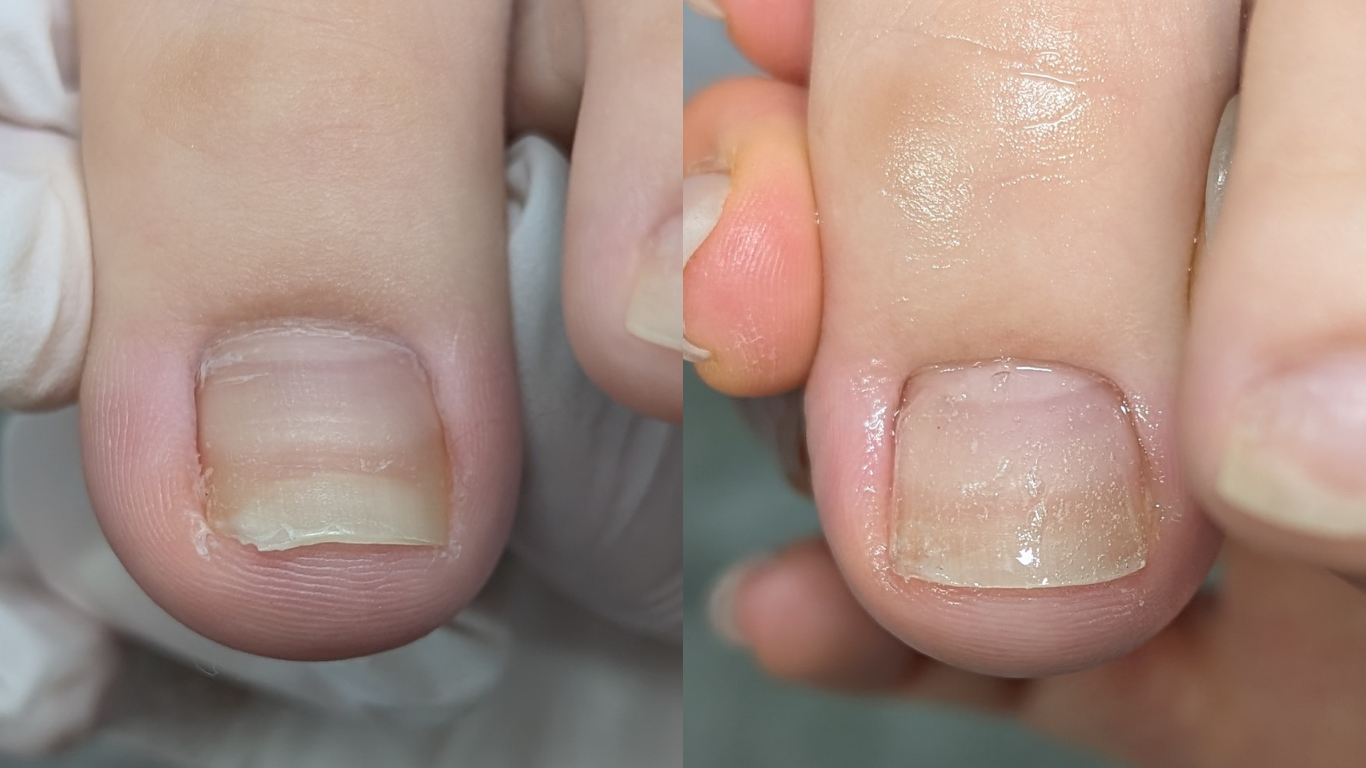 爪が短くて食い込んだ爪の巻き爪補正